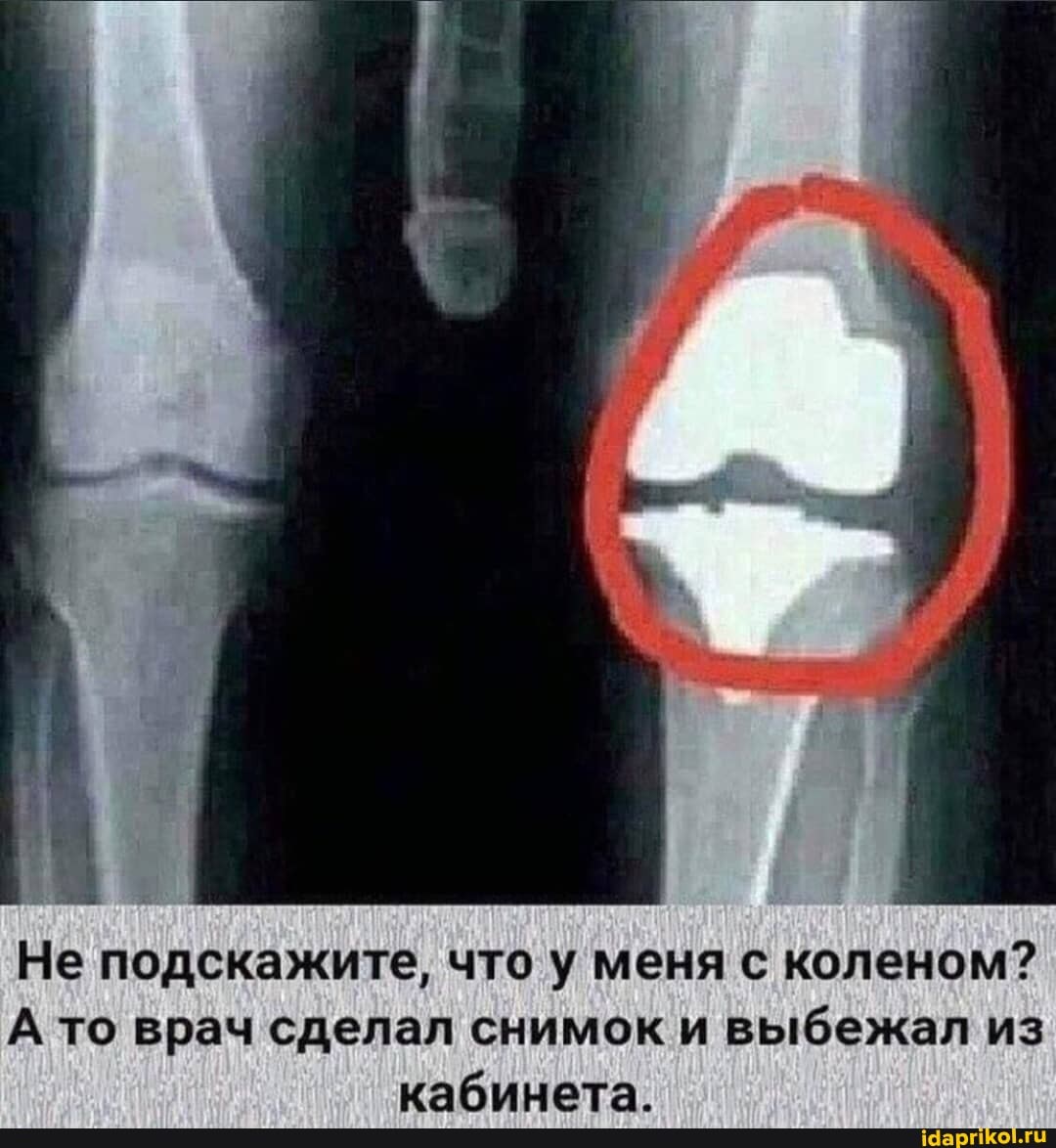 Не подскажите, что у меня с коленом?
А то врач сделал снимок и выбежал из кабинета_