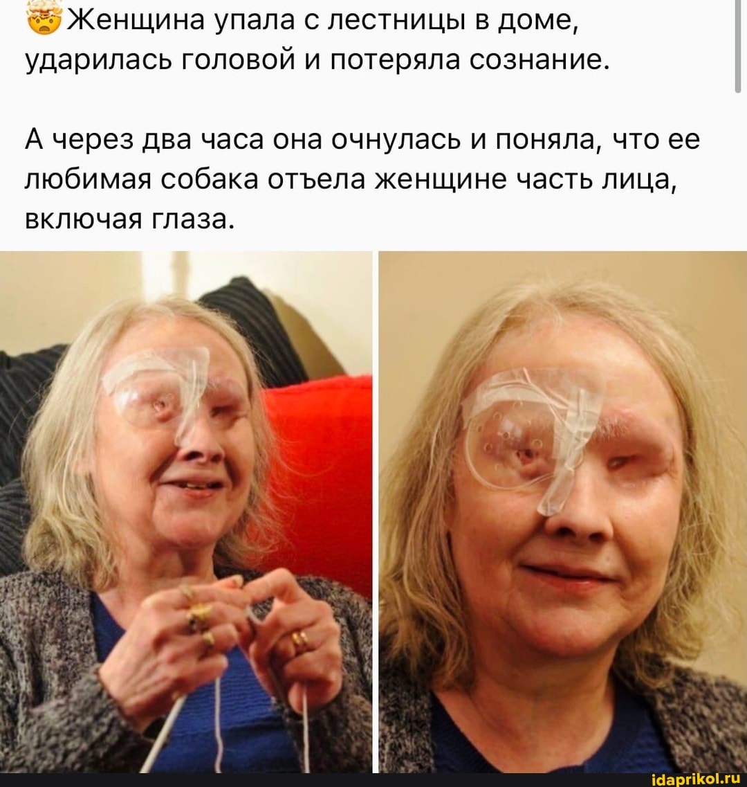 Женщина упала с лестницы в доме, ударилась головой и потеряла сознание.
А через два часа она очнулась и поняла, что ее любимая собака отела женщине часть лица,
включая глаза.